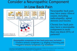 Consider a Neuropathic Component in Low Back Pain Neuropathic symptoms in low back pain may include4: Positive sensory symptoms, e.g. tingling or burning pain Negative sensory symptoms, e.g. numbness 1. Kavoussi R.  Eur Neuropsychopharmacol. 2006 Jul;16 Suppl 2:S128-33.  2. Devor M. In: McMahon SB, Koltzenburg M, editors. Textbook of Pain.  London: Elsevier; 2006. pp.905-28. 3. Baron R. Nat Clin Pract Neurol. 2006;2(2):95-106.   4. Audette JF, et al. Curr Pain Headache Rep  2005;9(3):168-77. 5.  Freynhagen R,  et al.  Curr Med Res Opin. 2006;22:1911-20. Excessive release of neurotransmitters2,3 Neuropathic back pain may have  many clinical causes, including radiculopathy, spinal stenosis and trauma Chronic low back pain may have a  neuropathic component in more than one-third (55%) of patients5 