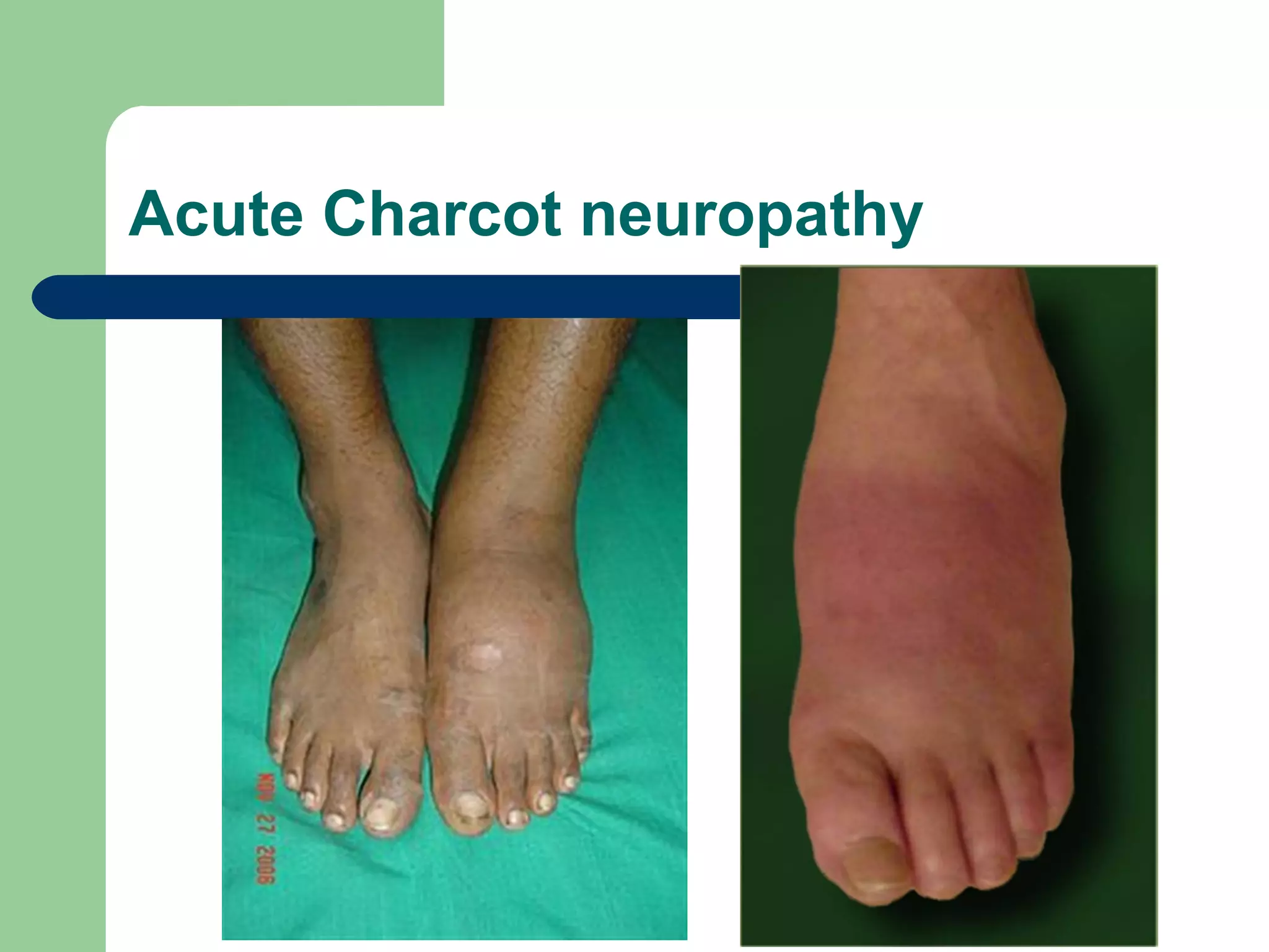 Acute Charcot neuropathy
 