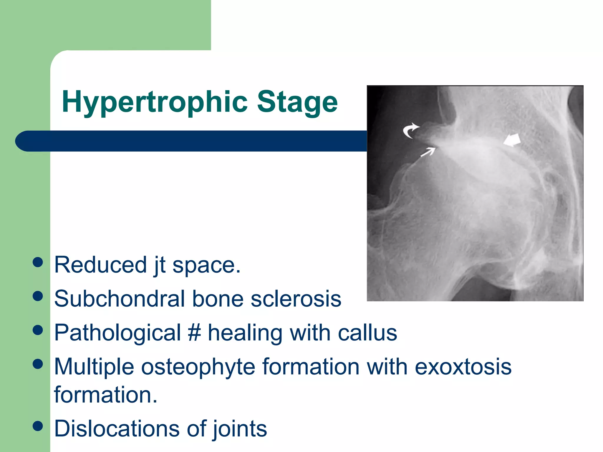 Hypertrophic Stage
 Reduced jt space.
 Subchondral bone sclerosis
 Pathological # healing with callus
 Multiple osteophyte formation with exoxtosis
formation.
 Dislocations of joints
 