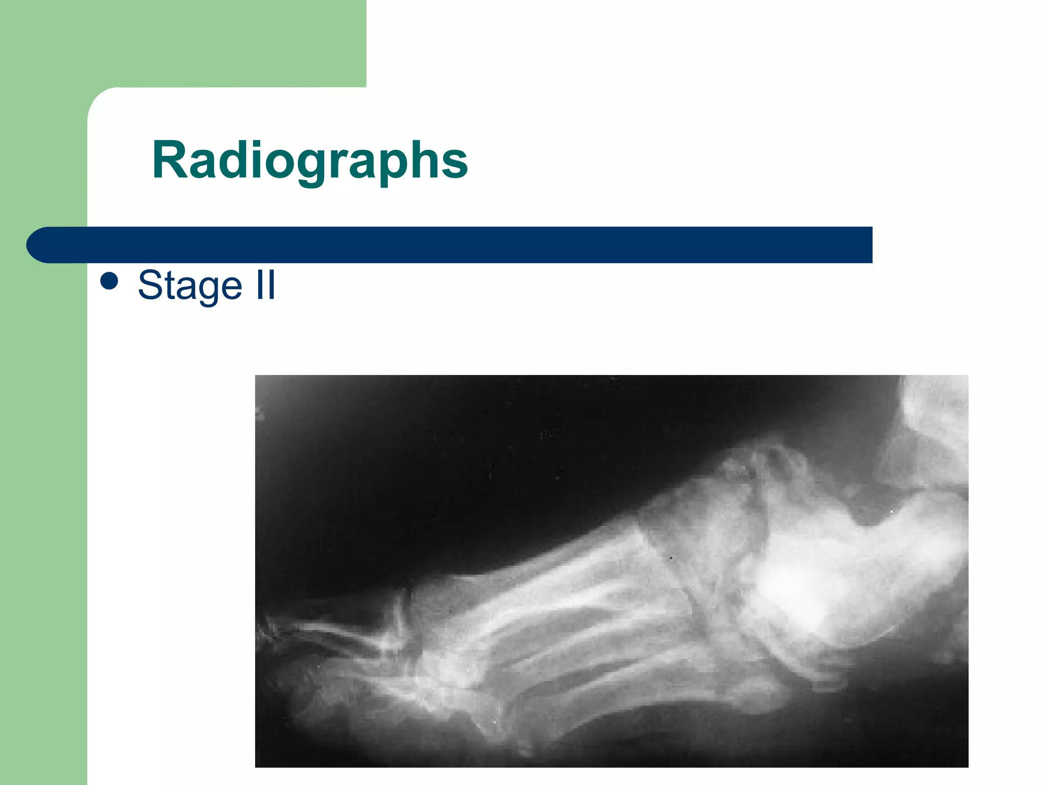 Radiographs
 Stage II
 