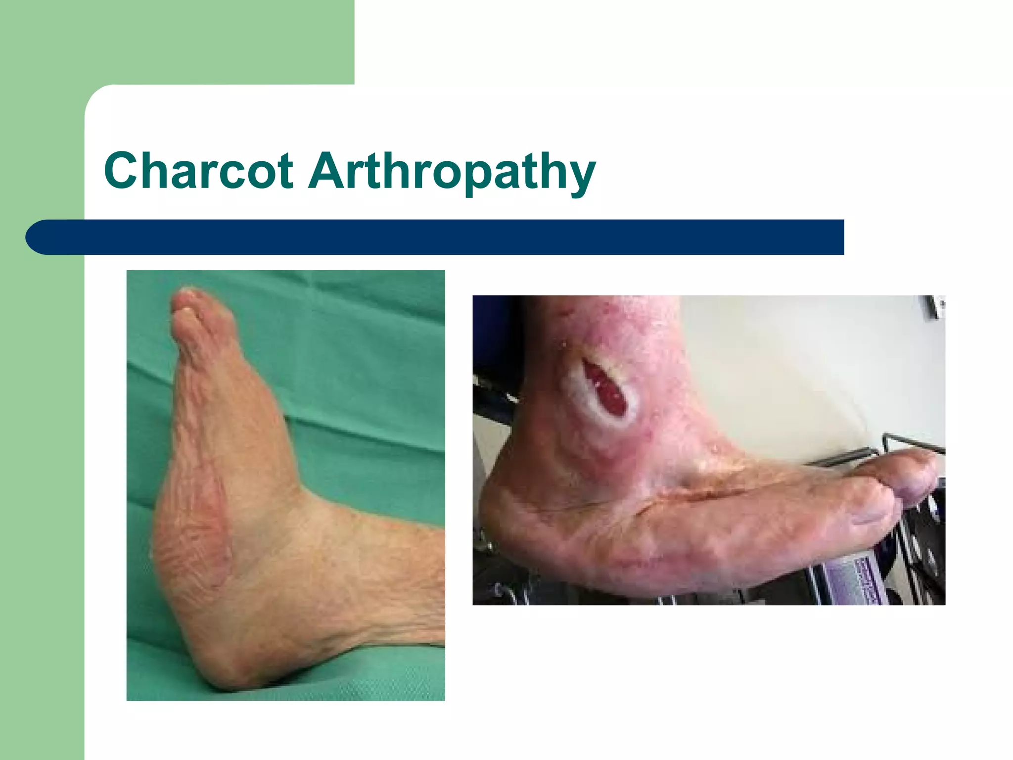 Charcot Arthropathy
 