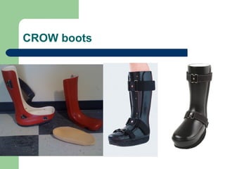 Open Crow Boot Neuropathic (Charcots) joints | PPT