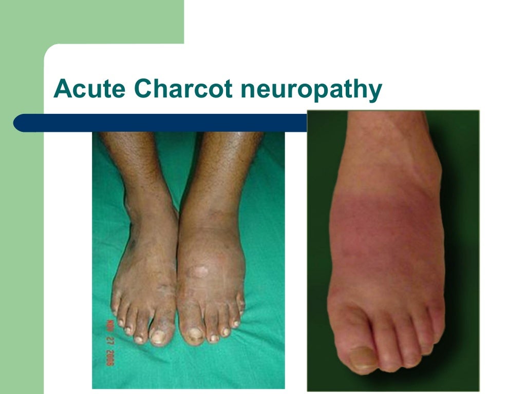 Neuropathic (Charcots) joints