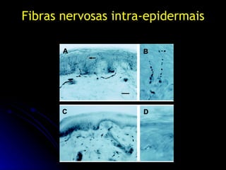 Fibras nervosas intra-epidermais 