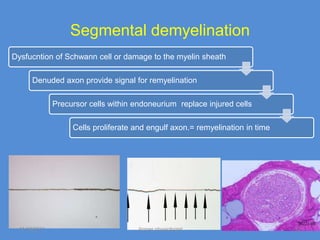 Segmental demyelination
Dysfucntion of Schwann cell or damage to the myelin sheath

       Denuded axon provide signal for remyelination

               Precursor cells within endoneurium replace injured cells

                    Cells proliferate and engulf axon.= remyelination in time




  11/19/2011                          Jipmer physiologist                       17
 