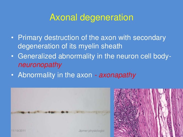 Neuropathies & myopathies an overview