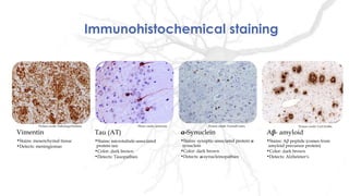 Vimentin
•Stains: mesenchymal tissue
•Detects: meningiomas
Tau (AT)
•Stains: microtubule-associated
protein tau
•Color: dark brown
•Detects: Tauopathies
α-Synuclein
•Stains: synaptic-associated protein α
synuclein
•Color: dark brown
•Detects: α-synucleinopathies
Aβ- amyloid
•Stains: Aβ peptide (comes from
amyloid precursor protein)
•Color: dark brown
•Detects: Alzheimer's
Immunohistochemical staining
Picture credit: PathologyOutlines Picture credit: FrontalCortex Picture credit: Carl HobbsPhoto credit: alzforum
 