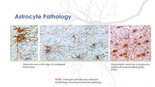 Astrocyte Pathology
Astrocytes seen at the edge of a malignant
brain tumor
Hypertrophic astrocytes in progressive
multifocal Leukoencephalopathy
(PML)
NOTE: Astrocytes will often have aberrant
morphology according to particular pathology
 