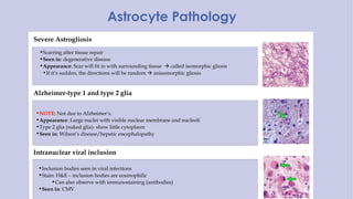 Severe Astrogliosis
•Scarring after tissue repair
•Seen in: degenerative disease
•Appearance: Scar will fit in with surrounding tissue  called isomorphic gliosis
•If it’s sudden, the directions will be random  anisomorphic gliosis
Alzheimer-type 1 and type 2 glia
•NOTE: Not due to Alzheimer’s.
•Appearance: Large nuclei with visible nuclear membrane and nucleoli
•Type 2 glia (naked glia)- show little cytoplasm
•Seen in: Wilson’s disease/hepatic encephalopathy
Intranuclear viral inclusion
•Inclusion bodies seen in viral infections
•Stain: H&E – inclusion bodies are eosinophilic
•Can also observe with immunostaining (antibodies)
•Seen in: CMV
Astrocyte Pathology
 
