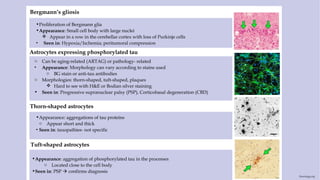 Astrocytes expressing phosphorylated tau
Bergmann’s gliosis
•Proliferation of Bergmann glia
•Appearance: Small cell body with large nuclei
 Appear in a row in the cerebellar cortex with loss of Purkinje cells
• Seen in: Hypoxia/Ischemia; peritumoral compression
Thorn-shaped astrocytes
•Appearance: aggregations of tau proteins
o Appear short and thick
• Seen in: tauopathies- not specific
Tuft-shaped astrocytes
•Appearance: aggregation of phosphorylated tau in the processes
o Located close to the cell body
•Seen in: PSP  confirms diagnosis
o Can be aging-related (ARTAG) or pathology- related
• Appearance: Morphology can vary according to stains used
o BG stain or anti-tau antibodies
o Morphologies: thorn-shaped, tuft-shaped, plaques
 Hard to see with H&E or Bodian silver staining
• Seen in: Progressive supranuclear palsy (PSP), Corticobasal degeneration (CBD)
Neurology.org
 