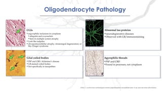 CGIs
•argyrophilic inclusions in cytoplasm
•ubiquitin and α-synuclein
•Seen in multiple system atrophy
•Look like tadpoles
•olivopontocerebellar atrophy, striatonigral degeneration, or
Shy–Drager syndrome
CGIs
•argyrophilic inclusions in cytoplasm
•ubiquitin and α-synuclein
•Seen in multiple system atrophy
•Look like tadpoles
•olivopontocerebellar atrophy, striatonigral degeneration, or
Shy–Drager syndrome
Abnormal tau proteins
•neurodegnerative diseases
•Observed with GB/immunostaining
Abnormal tau proteins
•neurodegnerative diseases
•Observed with GB/immunostaining
Glial coiled bodies
•PSP and CBD, Alzheimer’s disease
•GB-stained coiled bodies
•Not specifically in tauopathies
Glial coiled bodies
•PSP and CBD, Alzheimer’s disease
•GB-stained coiled bodies
•Not specifically in tauopathies
Agyrophilic threads
•PSP and CBD
•Found in processes, not cytoplasm
Agyrophilic threads
•PSP and CBD
•Found in processes, not cytoplasm
Oligodendrocyte PathologyOligodendrocyte Pathology
CHAO, L. et al Recurrence and histological evolution of dysembryoplastic neuroepithelial tumor: A case report and review of the literature.
 