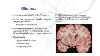 GliomasGliomas
 