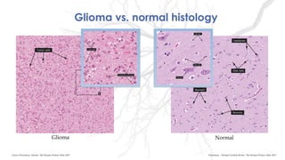 Glioma vs. normal histology
Glioma Normal
Dictionary – Normal Cerebral Bortex- The Human Protein Atlas 2017Cancer Dictionary- Glioma- The Human Protein Atlas 2017
 
