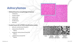 Astrocytomas
• Defined based on morphological features
1. Cellularity
2. nuclear atypia
3. mitotic rate
4. endothelial
5. Proliferation
6. Necrosis
• Graded based off of WHO classification system
1. pilocytic astrocytoma (Grade I)
2. astrocytoma (Grade II)
• Diffuse
1. anaplastic astrocytoma (Grade III)
• Diffuse
1. glioblastoma (Grade IV)
• Diffuse
Suck et al. 2015Webpathology.com
 