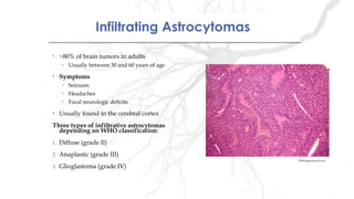 Infiltrating AstrocytomasInfiltrating Astrocytomas
• ~80% of brain tumors in adults
• Usually between 30 and 60 years of age
• Symptoms
• Seizures
• Headaches
• Focal neurologic deficits
• Usually found in the cerebral cortex
Three types of infiltrative astrocytomas
depending on WHO classification:
1. Diffuse (grade II)
2. Anaplastic (grade III)
3. Glioglastoma (grade IV)
Pathologystudent.com
 