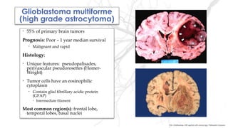Glioblastoma multiforme
(high grade astrocytoma)
• 55% of primary brain tumors
Prognosis: Poor – 1 year median survival
• Malignant and rapid
Histology:
• Unique features: pseudopalisades,
perivascular pseudorosettes (Homer-
Wright)
• Tumor cells have an eosinophilic
cytoplasm
• Contain glial fibrillary acidic protein
(GFAP)
• Intermediate filament
Most common region(s): frontal lobe,
temporal lobes, basal nuclei
File: Glioblastoma- MR sagittal with contrast.jpg- Wikimedia Commons
 