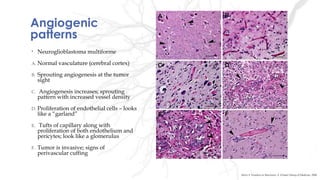 Angiogenic
patterns
• Neuroglioblastoma multiforme
A. Normal vasculature (cerebral cortex)
B. Sprouting angiogenesis at the tumor
sight
C. Angiogenesis increases; sprouting
pattern with increased vessel density
D. Proliferation of endothelial cells – looks
like a “garland”
E. Tufts of capillary along with
proliferation of both endothelium and
pericytes; look like a glomerulus
F. Tumor is invasive; signs of
perivascular cuffing
Stiver S. Frontiers in Bioscience: A Virtual Library of Medicine, 2004
 