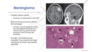 MeningiomaMeningioma
• Usually affects adults
• Common in individuals with NF2
• Derives from precursor cells to
the meninges
• Usually a good prognosis unless
the meningioma develops in a
critical area (e.g. grows in the
posterior fossa towards the
medulla)
• Usually well-defined and
rounded. Can extend into bone
and press on brain, but usually
operable
Pathologyoutlines.com
 