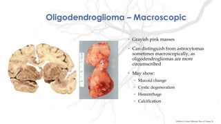 Oligodendroglioma – Macroscopic
• Grayish pink masses
• Can distinguish from astrocytomas
sometimes macroscopically, as
oligodendrogliomas are more
circumscribed
• May show:
• Mucoid change
• Cystic degeneration
• Hemorrhage
• Calcification
Robbins & Cotran Pathologic Basis of Disease, 9e
 
