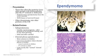 Ependymoma
Robbins & Cotran Pathologic Basis of Disease, 9e
 