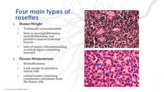 Four main types of
rosettes
1. Homer-Wright
1. Technically a pseudorosette
2. Seen in neuroglioblastoma,
medulloblastoma, and
primitive neuroectodermal
tumors
3. halo of tumor cells surrounding
a central region containing
neuropil
2. Flexner-Wintersteiner
1. Retinoblastoma
2. Look similar to primitive
retinal cells
3. central lumen containing
cytoplasmic extensions from
the tumor cells
Kristine Krafts, MD Pathology Student
 