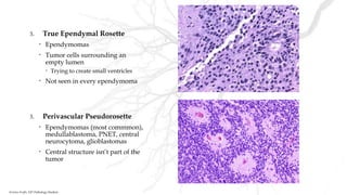 3. True Ependymal Rosette
• Ependymomas
• Tumor cells surrounding an
empty lumen
• Trying to create small ventricles
• Not seen in every ependymoma
3. Perivascular Pseudorosette
• Ependymomas (most commmon),
medullablastoma, PNET, central
neurocytoma, glioblastomas
• Central structure isn’t part of the
tumor
Kristine Krafts, MD Pathology Student
 