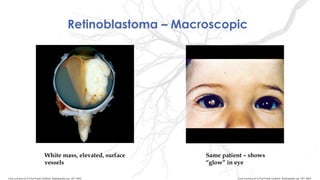Retinoblastoma – Macroscopic
White mass, elevated, surface
vessels
Same patient – shows
“glow” in eye
Case courtesy of A.Prof Frank Gaillard, Radiopaedia.org, rID: 9462Case courtesy of A.Prof Frank Gaillard, Radiopaedia.org, rID: 9461
 