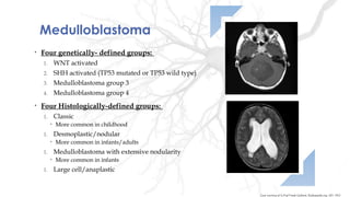 Medulloblastoma
• Four genetically- defined groups:
1. WNT activated
2. SHH activated (TP53 mutated or TP53 wild type)
3. Medulloblastoma group 3
4. Medulloblastoma group 4
• Four Histologically-defined groups:
1. Classic
• More common in childhood
1. Desmoplastic/nodular
• More common in infants/adults
1. Medulloblastoma with extensive nodularity
• More common in infants
1. Large cell/anaplastic
Case courtesy of A.Prof Frank Gaillard, Radiopaedia.org, rID: 7912
 