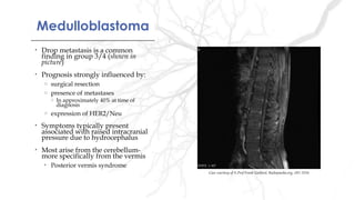 MedulloblastomaMedulloblastoma
• Drop metastasis is a common
finding in group 3/4 (shown in
picture)
• Prognosis strongly influenced by:
o surgical resection
o presence of metastases
o In approximately 40% at time of
diagnosis
o expression of HER2/Neu
• Symptoms typically present
associated with raised intracranial
pressure due to hydrocephalus
• Most arise from the cerebellum-
more specifically from the vermis
• Posterior vermis syndrome
Case courtesy of A.Prof Frank Gaillard, Radiopaedia.org, rID: 5316
 