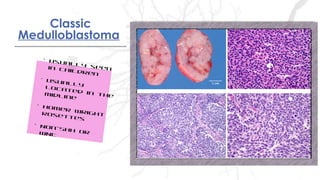Classic
Medulloblastoma
Classic
Medulloblastoma
• Usually seenin children
• Usuallylocated in themidline
• Homer wrightrosettes
• Non-SHH orWNT
 