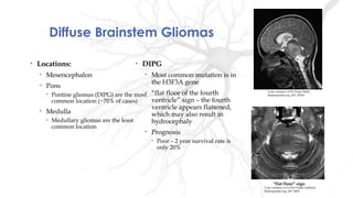 Diffuse Brainstem Gliomas
• Locations:
• Mesencephalon
• Pons
• Pontine gliomas (DIPG) are the most
common location (~70% of cases)
• Medulla
• Medullary gliomas are the least
common location
• DIPG
• Most common mutation is in
the H3F3A gene
• “flat floor of the fourth
ventricle” sign – the fourth
ventricle appears flattened,
which may also result in
hydrocephaly
• Prognosis
• Poor – 2 year survival rate is
only 20%
Case courtesy of Dr Vinay Shah,
Radiopaedia.org, rID: 20163
Case courtesy of A.Prof Frank Gaillard,
Radiopaedia.org, rID: 5683
“flat floor” sign
 