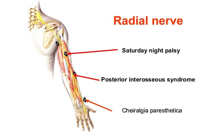 Neuropathy ..paras