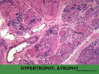 HYPERTROPHY, ATROPHY www.freelivedoctor.com 