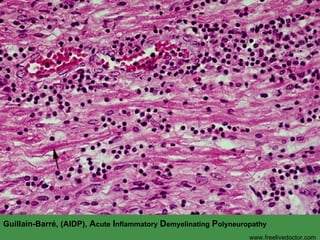 Guillain-Barr é, (AIDP),  A cute   I nflammatory   D emyelinating   P olyneuropathy www.freelivedoctor.com 
