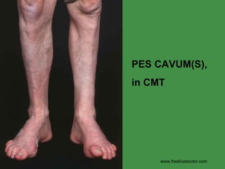 PES CAVUM(S),  in CMT www.freelivedoctor.com 