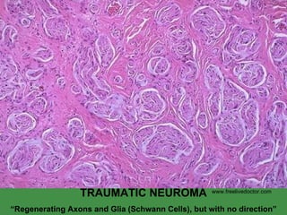 TRAUMATIC NEUROMA “ Regenerating Axons and Glia (Schwann Cells), but with no direction” www.freelivedoctor.com 