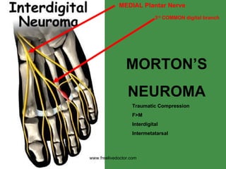 MORTON’S NEUROMA Traumatic Compression F>M Interdigital Intermetatarsal MEDIAL Plantar Nerve 3 rd  COMMON digital branch www.freelivedoctor.com 