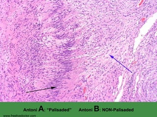 Antoni  A : “Palisaded”  Antoni  B : NON-Palisaded www.freelivedoctor.com 