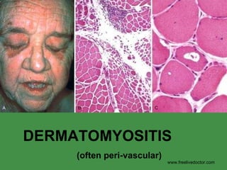 DERMATOMYOSITIS (often peri-vascular) www.freelivedoctor.com 