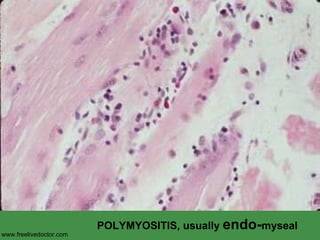 POLYMYOSITIS, usually  endo- myseal www.freelivedoctor.com 