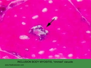 INCLUSION BODY MYOSITIS, “rimmed” vacuole www.freelivedoctor.com 