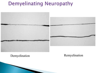 Demyelination Remyelination
 
