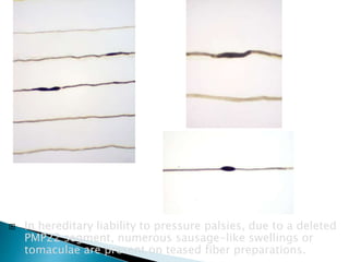  In hereditary liability to pressure palsies, due to a deleted
PMP22 segment, numerous sausage-like swellings or
tomaculae are present on teased fiber preparations.
 