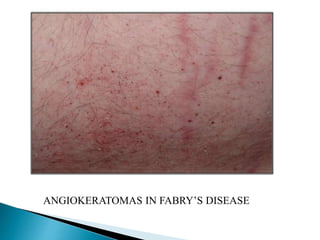 ANGIOKERATOMAS IN FABRY’S DISEASE
 