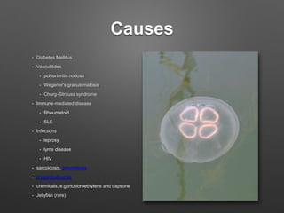 Causes
• Diabetes Mellitus
• Vasculitides
• polyarteritis nodosa,
• Wegener's granulomatosis,
• Churg–Strauss syndrome
• Immune-mediated disease
• Rheumatoid
• SLE
• Infections
• leprosy
• lyme disease
• HIV
• sarcoidosis, amyloidosis
• cryoglobulinemia
• chemicals, e.g trichloroethylene and dapsone
• Jellyfish (rare)
 