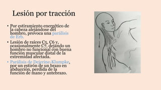 Lesión por tracción
• Por estiramiento energético de
la cabeza alejándose del
hombro, provoca una parálisis
de Erb.
• Lesión de raíces C5, C6 y,
ocasionalmente C7, dejando un
hombro no funcional con buena
función muscular distal de la
extremidad afectada.
• Parálisis de Dejerine-Klumpke,
por un estirón de un brazo en
abducción, perdida de la
función de mano y antebrazo.
 