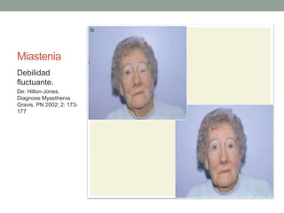 Miastenia
Debilidad
fluctuante.
De: Hilton-Jones.
Diagnose Myasthenia
Gravis. PN 2002; 2: 173-
177
 