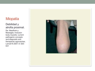 Miopatía
Debilidad y
atrofia proximal.
De: Needham y
Mastaglia. Inclusion
body myositis: current
pathogenic concepts
and diagnostic and
therapeutic approaches.
Lancet N 2007; 6: 620-
631
 