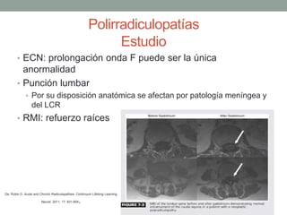Polirradiculopatías
Estudio
• ECN: prolongación onda F puede ser la única
anormalidad
• Punción lumbar
• Por su disposición anatómica se afectan por patología meníngea y
del LCR
• RMI: refuerzo raíces
De: Rubin D. Acute and Chronic Radiculopathies. Continuum Lifelong Learning
Neurol. 2011; 17: 831-854.
 