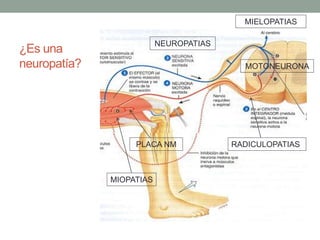 ¿Es una
neuropatía?
MIELOPATIAS
MOTONEURONA
RADICULOPATIAS
NEUROPATIAS
PLACA NM
MIOPATIAS
 